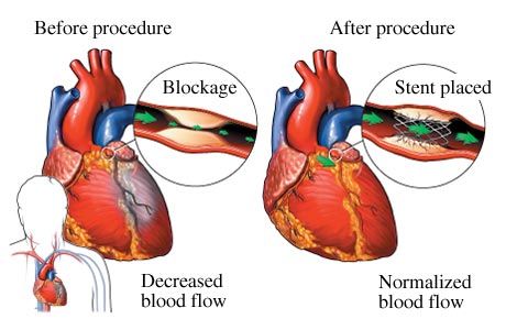 stent